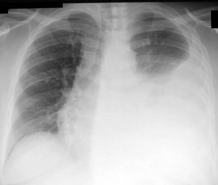 Frontal chest radiograph showing dense homogeneous white opacification occupying most of the left hemithorax with a curved upper border, obscuring the left hemidiaphragm and heart border, while the right lung appears normally aerated.