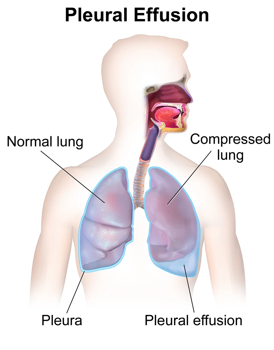 Labelled medical illustration of the chest showing a normal lung on one side and, on the other, a pleural effusion - a pale blue collection of fluid at the lung base with the lung above it compressed and reduced in volume.