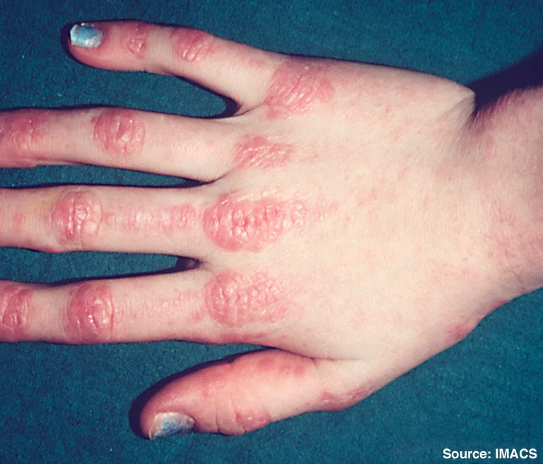 Photograph of the back of a hand showing scaly, erythematous papules over the knuckles at the metacarpophalangeal and interphalangeal joints, consistent with Gottron's papules of dermatomyositis.