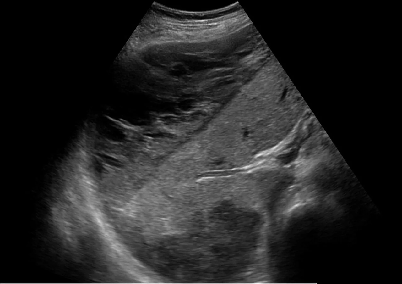 Abdominal ultrasound showing a large hypoechoic subcapsular collection over the surface of the liver.