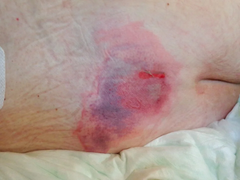 Photograph of the sacral area showing an area of non-blanching, dusky red to purple erythema with a small area of superficial skin breakdown, typical of an early-stage pressure injury.