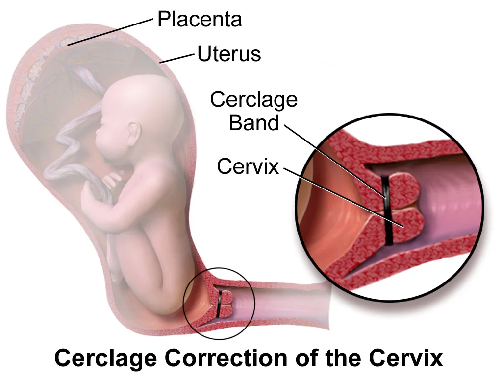 Diagram of a cervical cerclage suture placed around the cervix, with an inset showing the band in position.