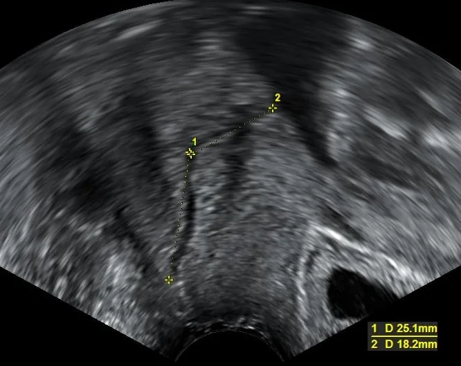 Transvaginal ultrasound image measuring the length of the cervix in a pregnancy at 22 weeks.