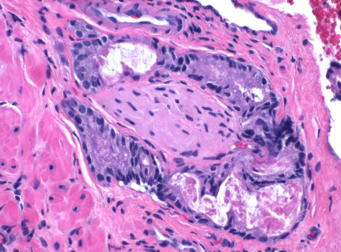 Light micrograph of prostate tissue stained with haematoxylin and eosin showing small crowded irregular malignant glands surrounding and encircling a peripheral nerve.