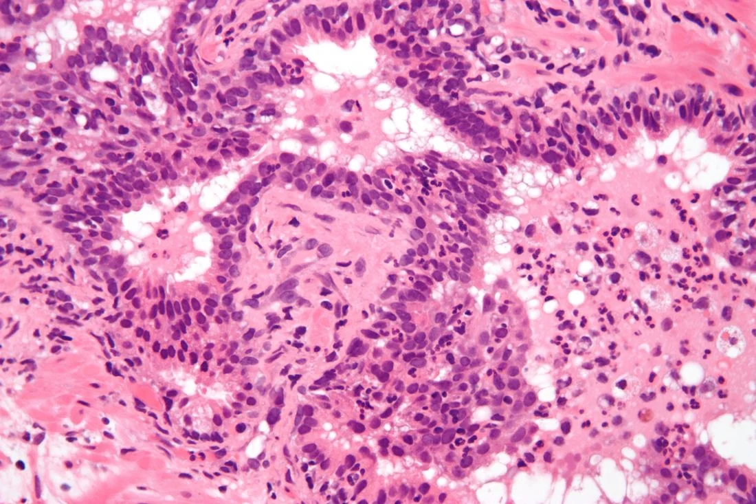 Light micrograph of prostate tissue stained with haematoxylin and eosin showing a dense infiltrate of neutrophils within and around the prostatic glands and stroma.
