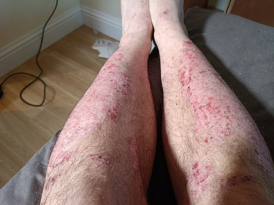 Photograph of chronic plaque psoriasis on the shins, showing multiple well-demarcated, raised, erythematous plaques covered with thick silvery-white scale.