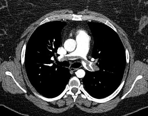Axial CT pulmonary angiogram at the level of the pulmonary trunk showing bright contrast in the aorta but dark, non-enhancing filling defects occupying the lumen of both main pulmonary arteries and extending across the bifurcation.