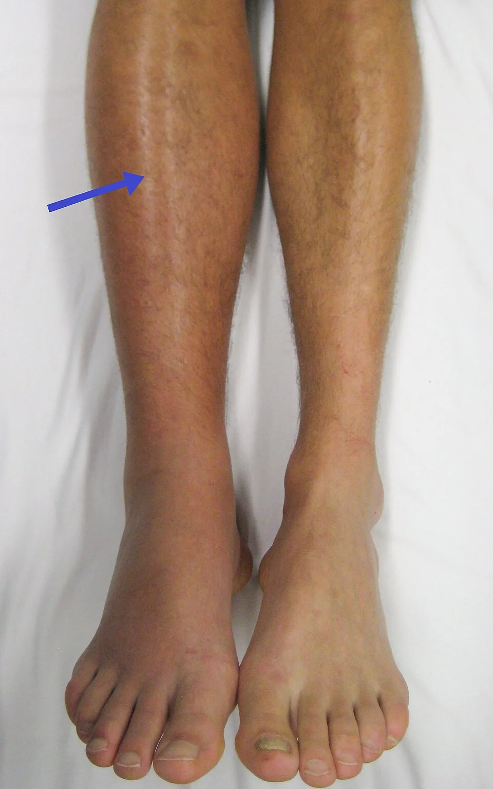 Photograph of both lower legs from the front, with an arrow indicating the right calf, which is visibly more swollen and slightly redder than the left.
