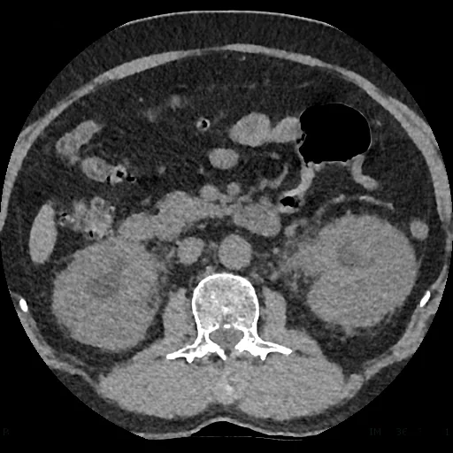 Axial non-contrast CT scan of the abdomen showing both kidneys surrounded by hazy increased density in the perinephric fat, consistent with inflammatory fat stranding in bilateral pyelonephritis.
