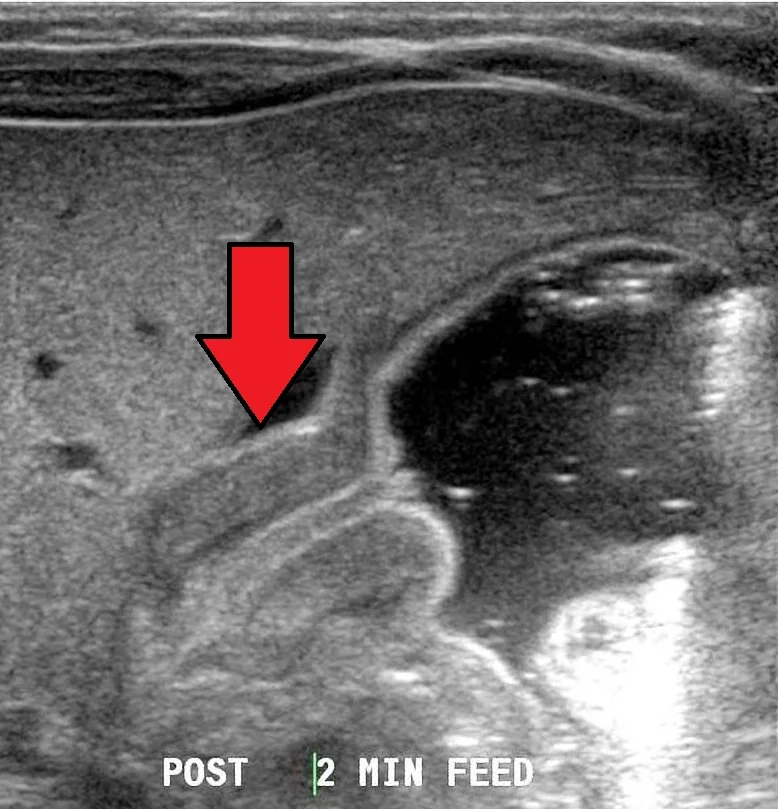 Abdominal ultrasound of an infant showing an elongated pylorus with a thickened hypoechoic muscular wall surrounding a narrow central echogenic channel.