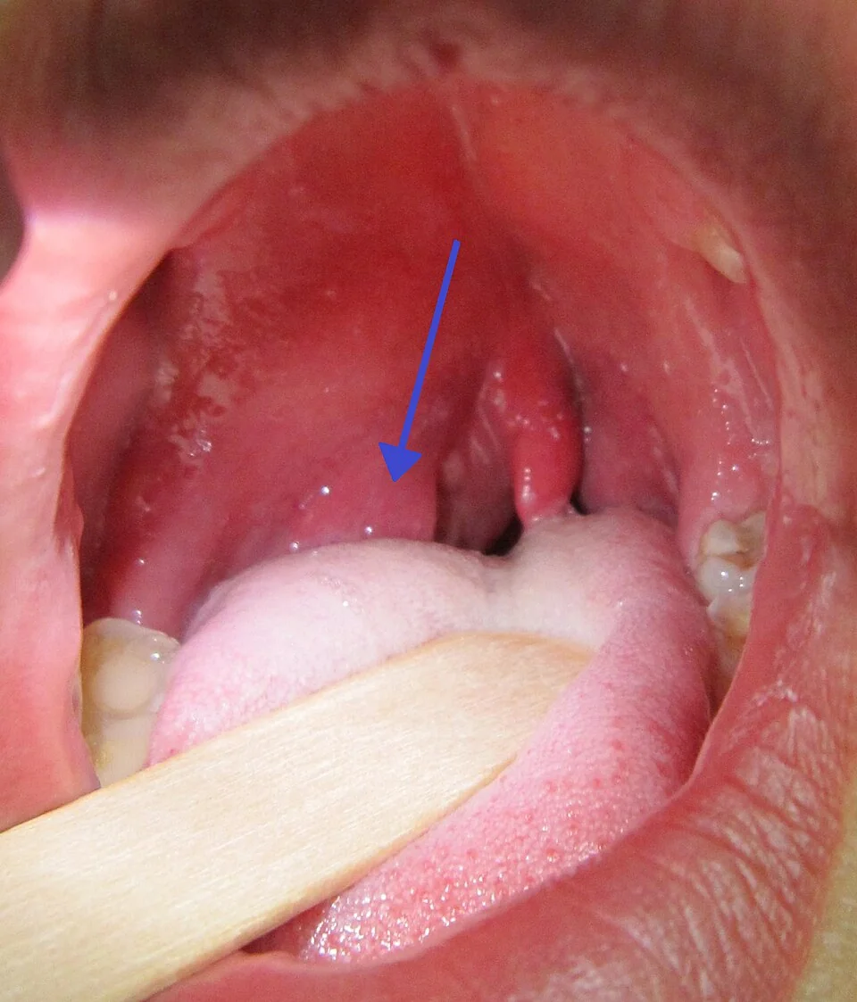 Photograph of the oral cavity showing a right-sided peritonsillar abscess, with marked swelling of the right soft palate and tonsillar region and deviation of the uvula to the left.