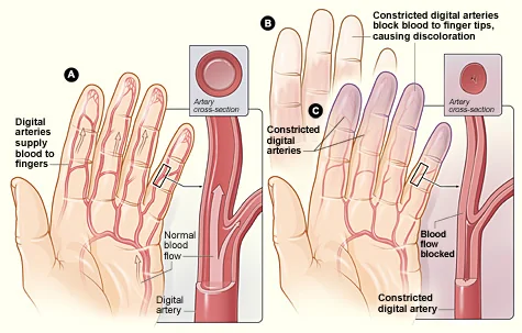 Diagram comparing a normal digital artery with normal blood flow against a digital artery in Raynaud phenomenon showing vasospastic narrowing and white discolouration of the fingertip.