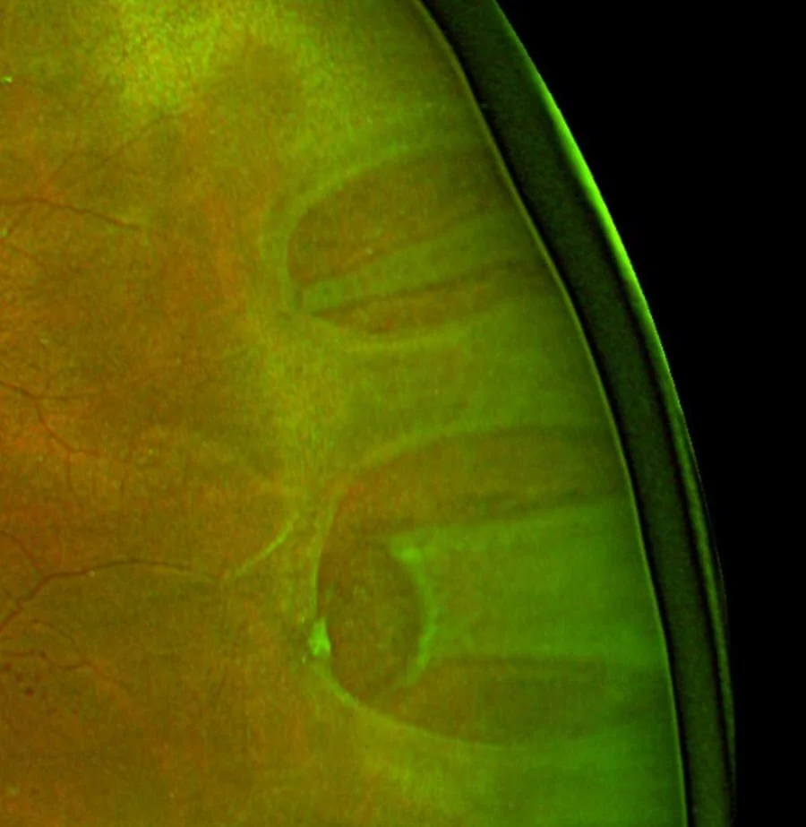Colour fundus photograph of a rhegmatogenous retinal detachment showing a horseshoe-shaped retinal tear with the surrounding retina elevated, pale and folded compared with the attached retina.