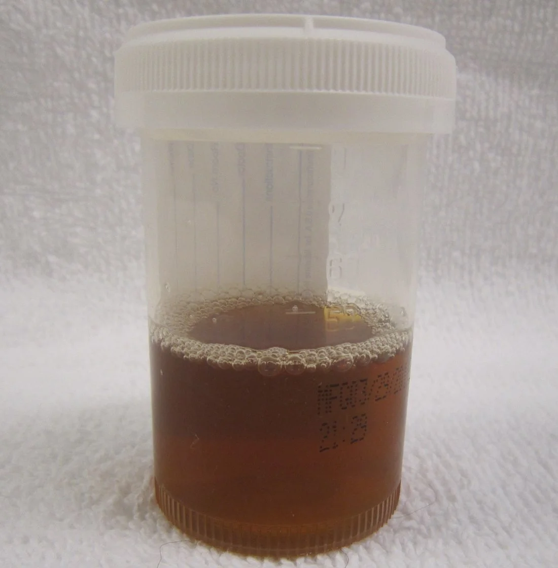 Photograph of a urine sample in a clear specimen container showing dark reddish-brown, tea-coloured discolouration typical of myoglobinuria.