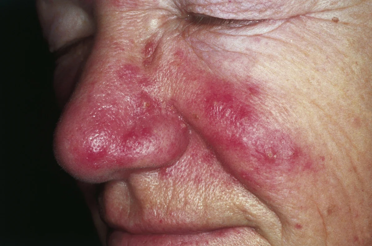 Photograph of a face with rosacea, showing erythema and telangiectasia over the cheeks, nasolabial area and nose, with inflammatory papules and pustules on the nose, and no comedones.