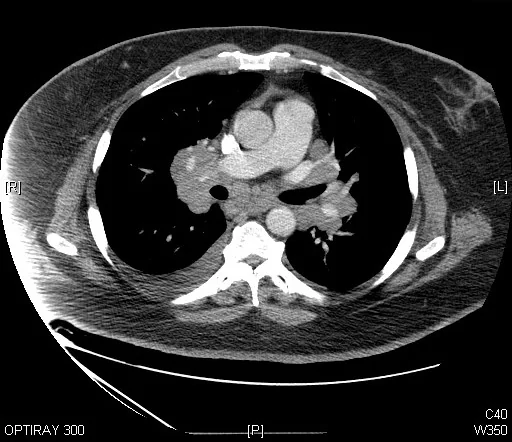 Axial contrast-enhanced CT of the chest showing multiple enlarged soft tissue density lymph nodes symmetrically distributed around both hila and throughout the mediastinum, adjacent to the airways and great vessels.