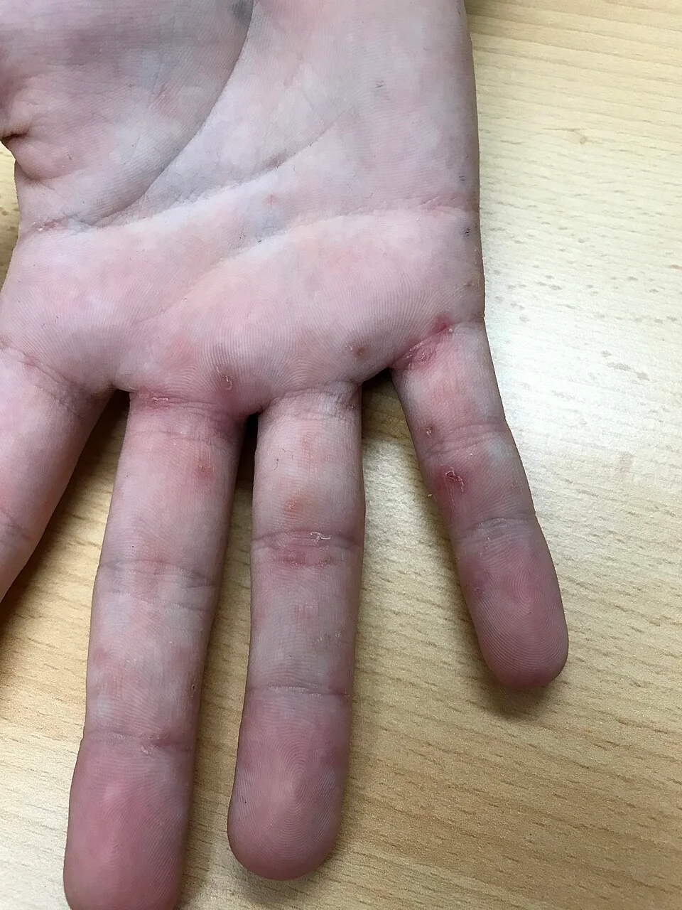 Photograph of a hand showing several small papules and burrows in the finger web spaces, a classic site for scabies infestation.
