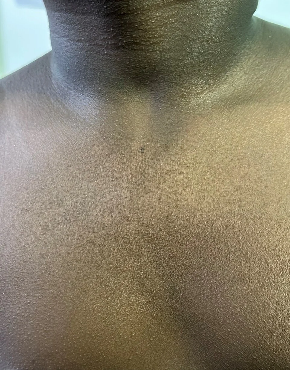 Fine, diffuse punctate red rash across the neck and upper trunk of a school-age child, densest in the skin creases of the neck.