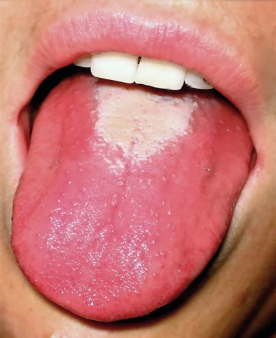 Close-up of a protruded tongue with a thick white coating through which enlarged red papillae project, giving a strawberry-like appearance.