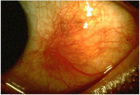 Photograph of an eye with scleritis showing intense deep redness of the sclera with a violaceous hue, most marked in one sector, with dilated deep vessels and a clear cornea.