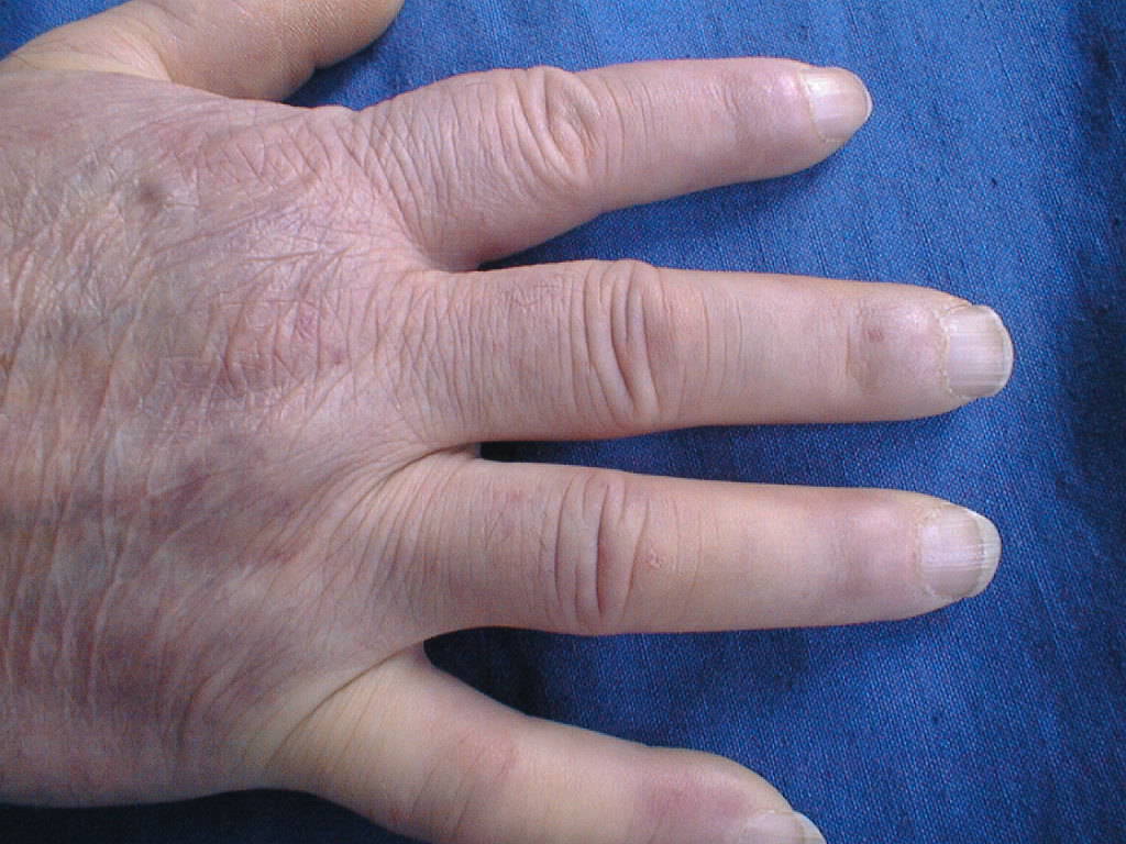 Photograph of fingers showing dark, tight, shiny skin over the distal phalanges, characteristic of sclerodactyly in systemic sclerosis.