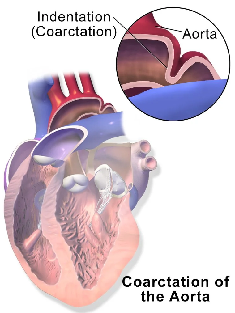 Illustration of the heart and aortic arch showing a coarctation - a discrete narrowing of the aorta just beyond the origin of the left subclavian artery, with the vessels to the head and arms arising before the narrowing.