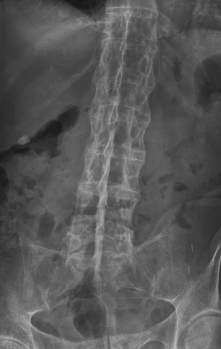 Lateral radiograph of the lumbar spine in advanced ankylosing spondylitis, showing vertical syndesmophytes bridging the vertebral bodies to produce the 'bamboo spine' appearance.