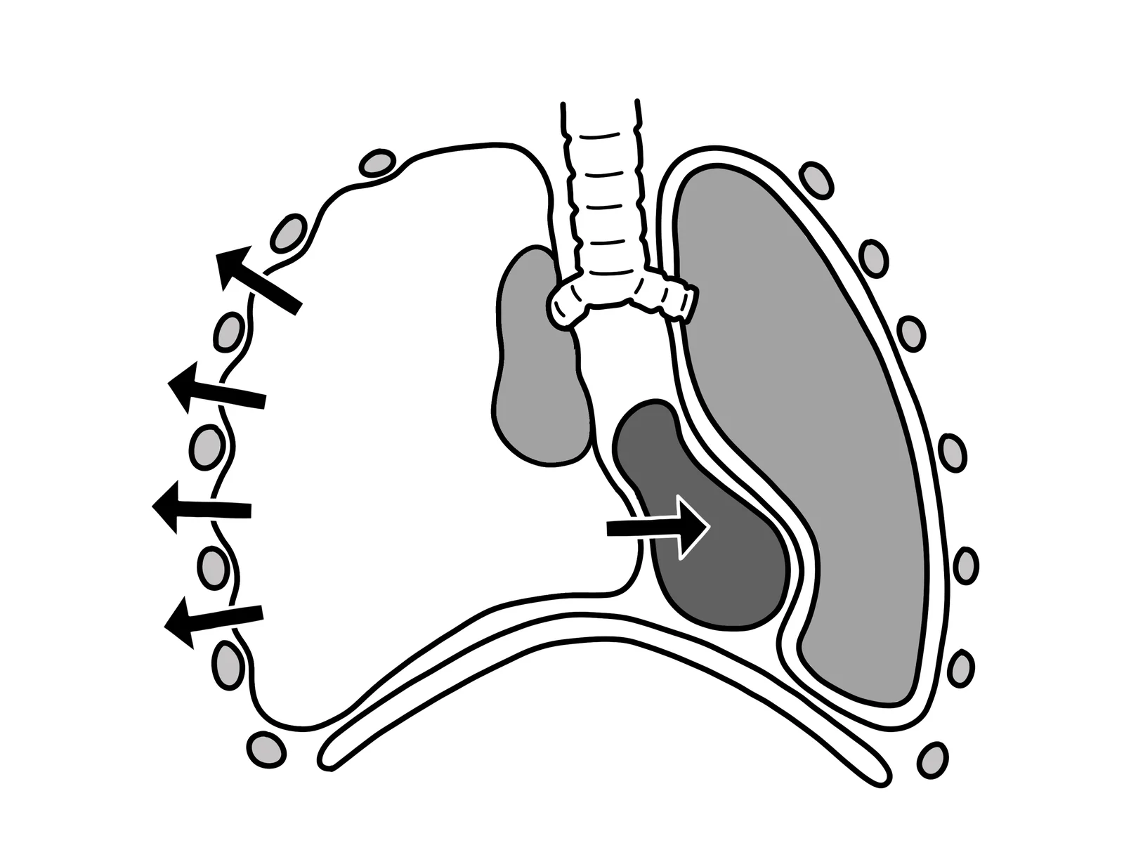 Diagram of the chest in tension pneumothorax. One pleural cavity is filled with air and expanded, with arrows showing outward pressure on the chest wall, the lung on that side collapsed, and the trachea and mediastinum pushed across towards the opposite side.