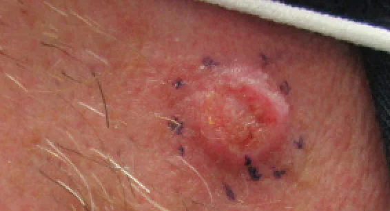 Close-up photograph of an invasive squamous cell carcinoma on the cheek, showing a firm, keratotic, indurated nodule with a crusted, ulcerated centre, marked for biopsy.