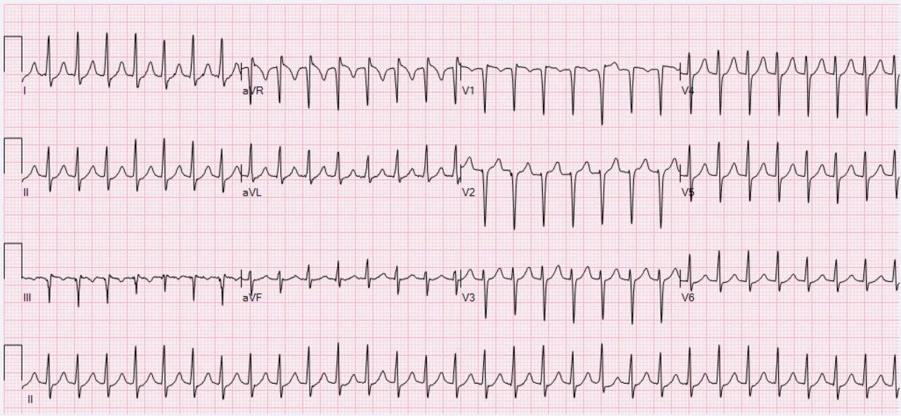 A 12-lead ECG showing a fast, regular, narrow complex tachycardia at approximately 180 beats per minute, with no clearly visible P waves before the QRS complexes.