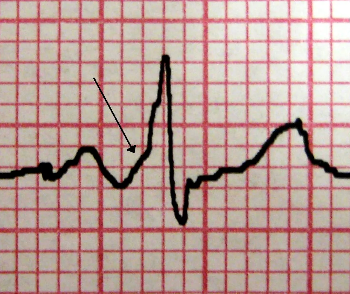 Close-up of a single ECG complex on graph paper, with an arrow pointing to the slurred initial upstroke of the QRS complex. The interval between the P wave and the start of the QRS is visibly short.