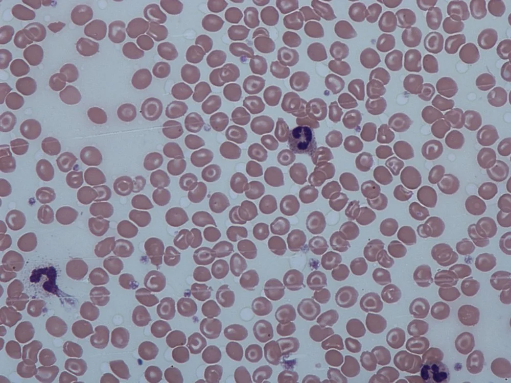 Peripheral blood film showing target cells, with a characteristic bull's-eye central density surrounded by a pale ring.