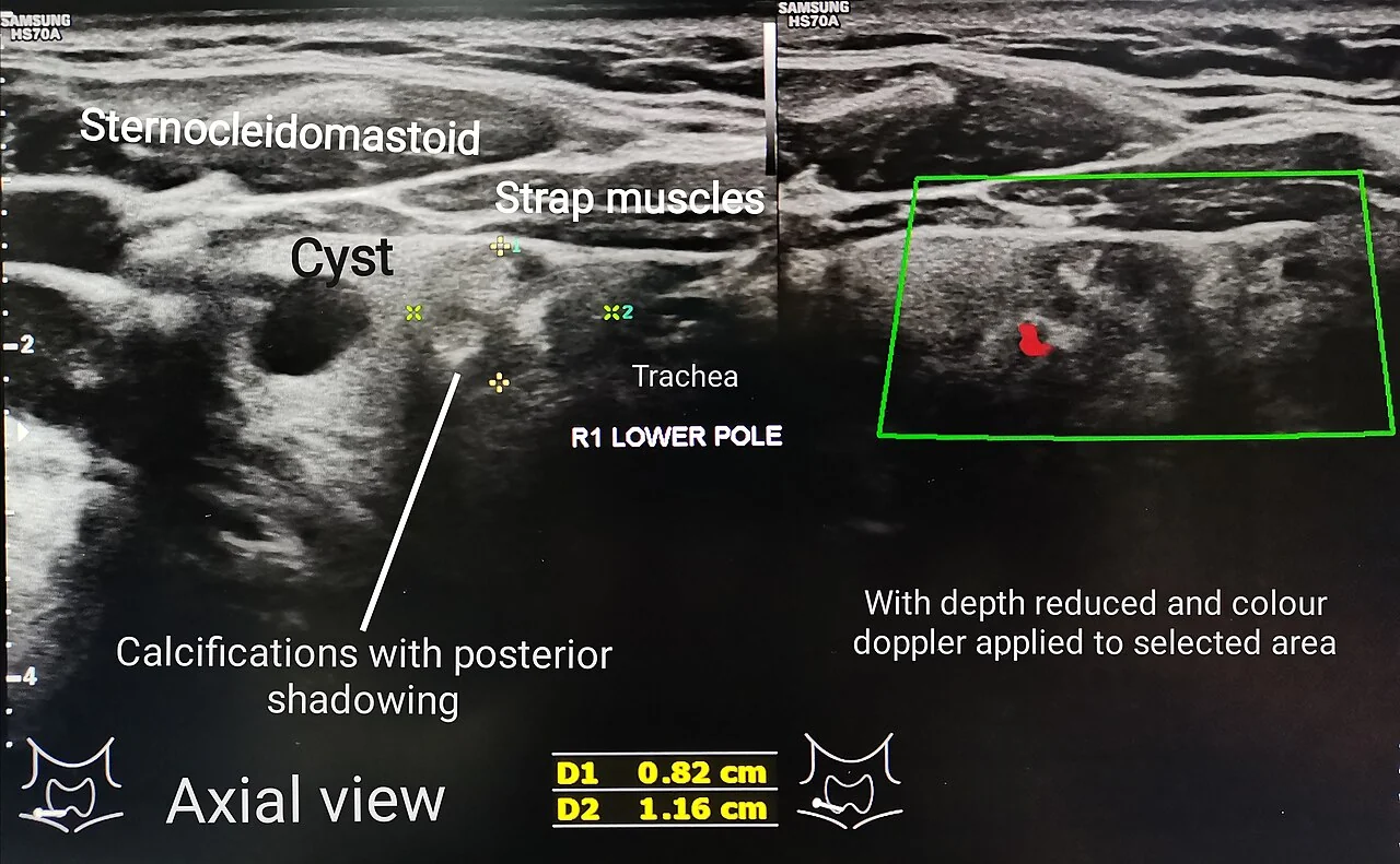 Annotated axial thyroid ultrasound image showing the sternocleidomastoid and strap muscles, the trachea, an anechoic rounded cyst in the right lower pole, and bright calcifications casting posterior acoustic shadows, with a colour Doppler box on the adjacent panel showing minimal internal vascularity.