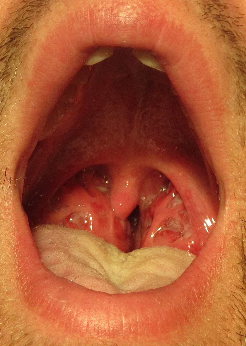 Photograph of a throat with erythematous, swollen tonsils covered in whitish exudate, typical of streptococcal tonsillitis.