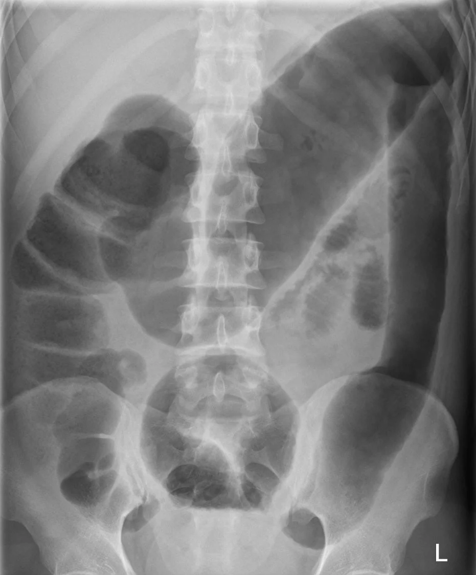 Abdominal imaging showing marked dilatation of the colon in a patient with toxic megacolon complicating ulcerative colitis.