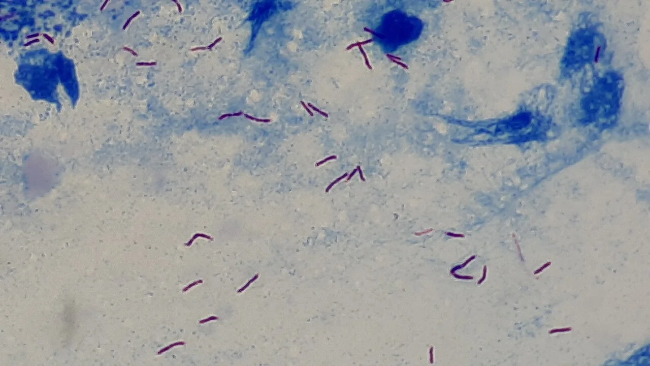 Ziehl-Neelsen stained sputum smear showing red, rod-shaped acid-fast bacilli against a blue background.