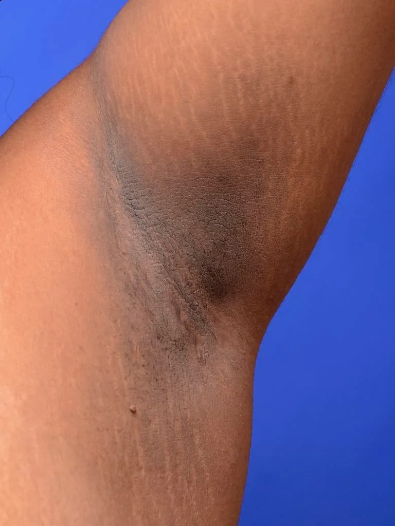 Close-up photograph of an axilla showing a well-demarcated area of dark grey-brown, velvety, thickened skin with accentuated skin lines, against surrounding normally pigmented skin.