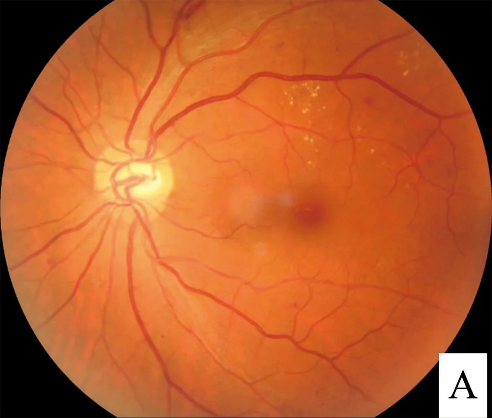 Colour fundus photograph of a retina showing the optic disc, branching retinal vessels, several small clusters of yellow-white hard exudates in the upper temporal region and scattered small red dots representing microaneurysms and dot haemorrhages.