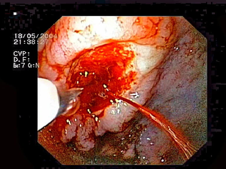 Endoscopic image showing a bleeding gastric ulcer with active haemorrhage.