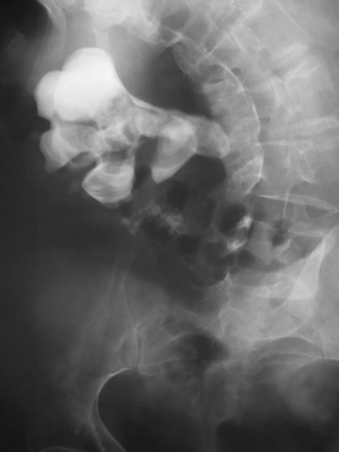 Plain abdominal radiograph (KUB) showing a large branching radio-opaque calculus occupying the renal pelvis and major calyces of one kidney, in a patient with marked scoliosis.