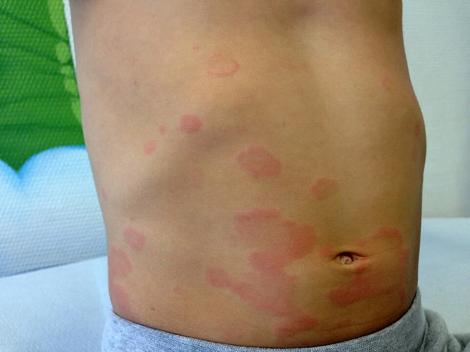 Photograph of a child's torso showing multiple raised, erythematous, well-demarcated urticarial wheals of varying size.