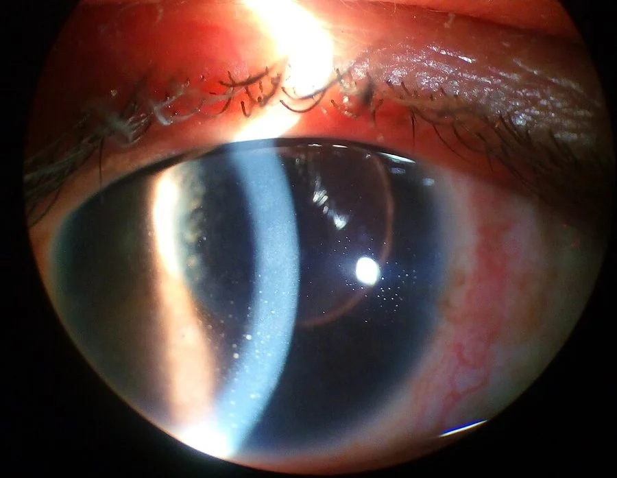 Slit lamp photograph showing keratic precipitates - discrete pale deposits of inflammatory cells clustered on the inner surface of the cornea - visible against the iris behind.