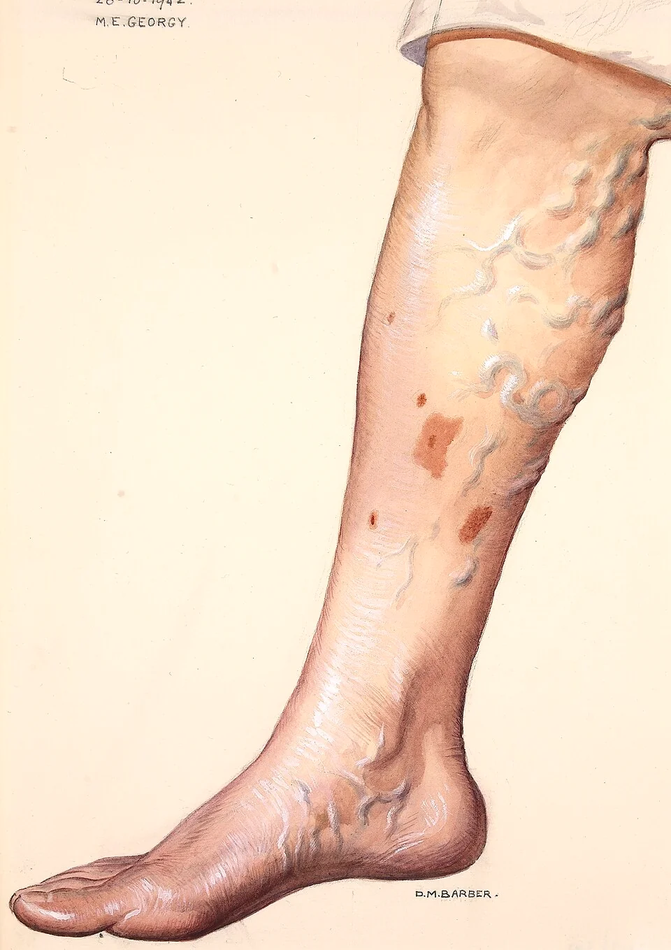 Clinical watercolour of a lower leg and foot showing prominent tortuous dilated superficial veins running up the medial calf, with several patches of brown pigmentation of the overlying skin.
