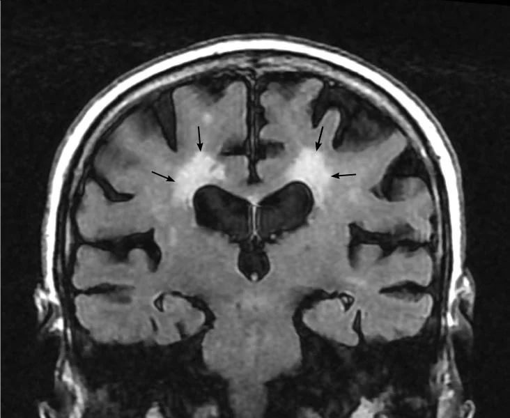 Axial MRI brain image showing extensive confluent high-signal change in the periventricular and deep white matter, together with widened sulci and enlarged ventricles indicating cerebral atrophy.
