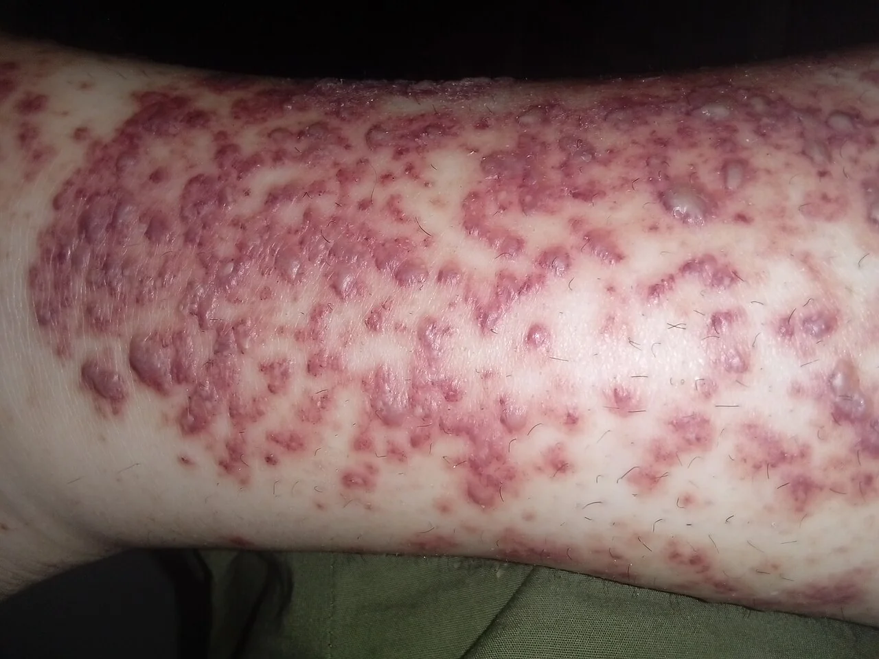 Photograph of the lower legs showing multiple raised, non-blanching purpuric spots and patches typical of cutaneous small vessel vasculitis.
