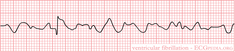 A single-lead ECG rhythm strip showing a chaotic, irregular, undulating waveform of varying amplitude with no identifiable P waves, QRS complexes or T waves.