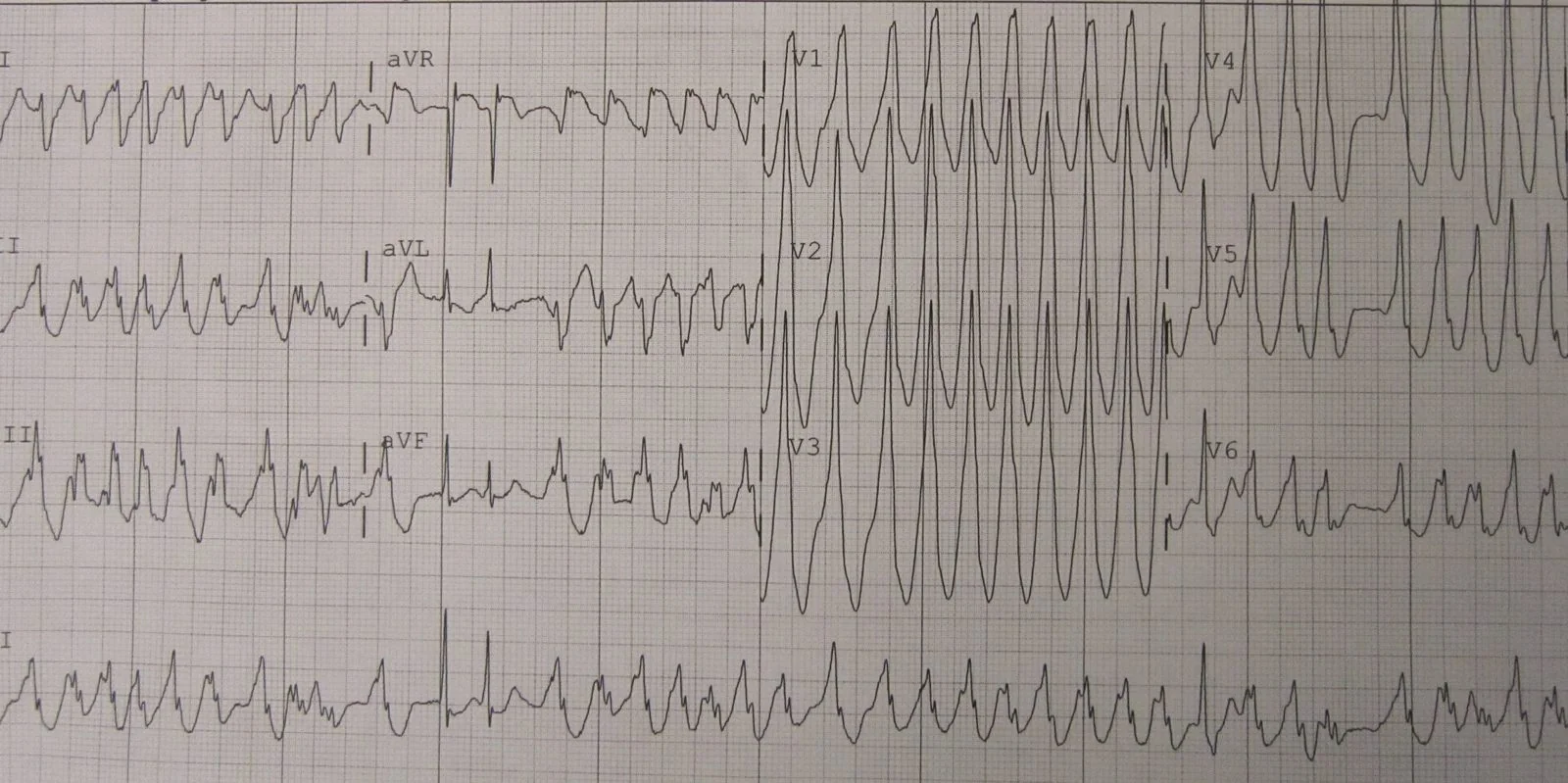 A 12-lead ECG showing a rapid, regular tachycardia in which every QRS complex is broad and all complexes share the same morphology, with no clearly related P waves.