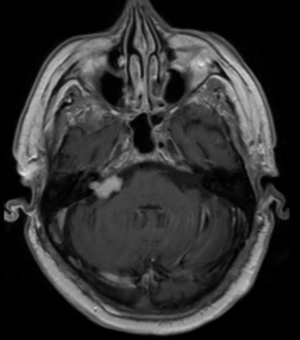 Axial post-contrast T1-weighted MRI at the level of the posterior fossa showing a small, brightly enhancing mass at the right cerebellopontine angle extending into the internal auditory canal.