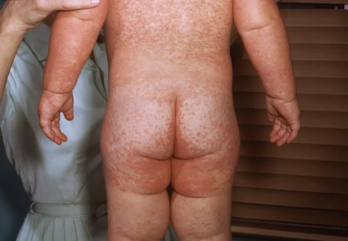 The back and buttocks of a child covered in a blotchy, partly confluent red maculopapular rash.