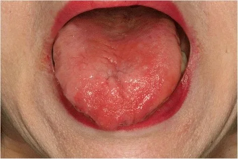 Photograph of a smooth, erythematous tongue with loss of papillae, consistent with glossitis in vitamin B12 deficiency.